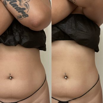 Sculpted - Stomach Treatment results after one session - Body Contouring Near Me Sculpted - Stomach Treatment results after one session - Body Contouring Near Me