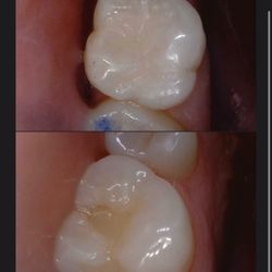 North Portland Dental Care - Before and after picture of my filling!