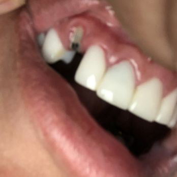 Reny Dental - Don't come here not unless you want your own tooth to break off - Cosmetic Dentists Near Me - Vicente Guerrero, BCN