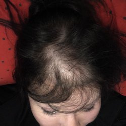 Metropolitan Plastic Surgery - This is what he Calls lowering the hairline