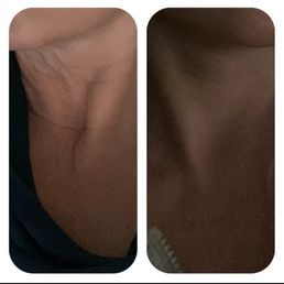 3 weeks post op. 3 weeks post op.