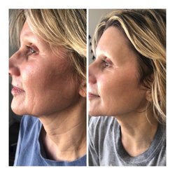 Fresh Faces & Body - before and after peel series