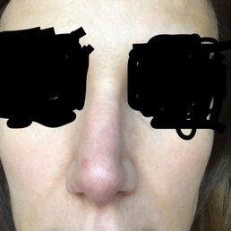 This was my result from Dr Dayan's rhinoplasty surgery. My nose is crooked and pinched on the one side. This was my result from Dr Dayan's rhinoplasty surgery. My nose is crooked and pinched on the one side.