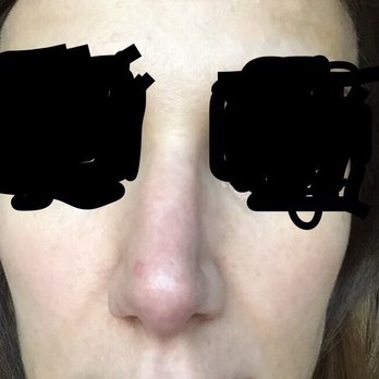 Steven H Dayan, MD, FACS - This was my result from Dr Dayan's rhinoplasty surgery. My nose is crooked and pinched on the one side. - Cosmetic Surgeons Near Me - Chicago, Illinois Steven H Dayan, MD, FACS - This was my result from Dr Dayan's rhinoplasty surgery. My nose is crooked and pinched on the one side. - Cosmetic Surgeons Near Me - Chicago, Illinois