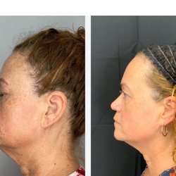 A Fresh Face Aesthetics - This is me before and then 30 days after my PDO threads were placed. I am so thrilled with the difference!