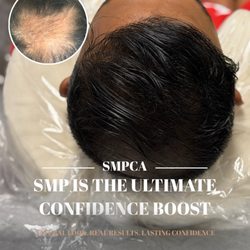 Scalp Micro Pigmentation