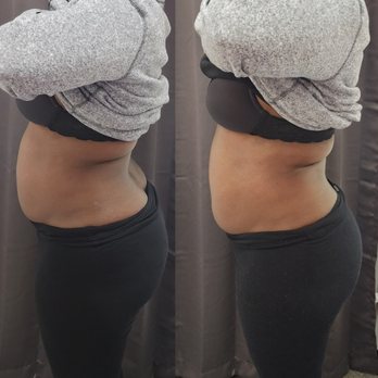 Suite Sculpt 35 - Stomach Cavaitation Therapy - Body Contouring Near Me - Irving, Texas Suite Sculpt 35 - Stomach Cavaitation Therapy - Body Contouring Near Me - Irving, Texas