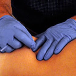 Greensboro Physical Therapy - Trigger Point Dry Needling