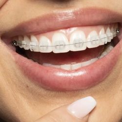 North County Orthodontics - LightForce brackets conform precisely to your teeth, often helping to reduce discomfort and improving the straightening accuracy.
