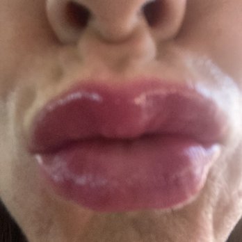 Renee Patel, MD - Day three after 2nd procedure with same syringe.  No bruising, light makeup. - Laser Hair Removal Near Me - Downey, California