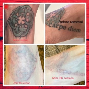 Regerts Ink Removal - After 9 tattoo removal sessions, the tattoo has significantly faded and may even be completely removed, depending on the size and color - Tattoo Removal Near Me - Yardley, Pennsylvania Regerts Ink Removal - After 9 tattoo removal sessions, the tattoo has significantly faded and may even be completely removed, depending on the size and color - Tattoo Removal Near Me - Yardley, Pennsylvania