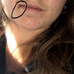 East Indy Dental Care - Wisdom Teeth Extraction July 2020