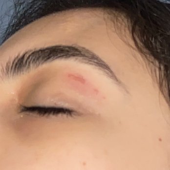 Wax Nail Hair Secrets - Burn from eyebrow wax - Waxing Near Me - Hialeah, Florida Wax Nail Hair Secrets - Burn from eyebrow wax - Waxing Near Me - Hialeah, Florida