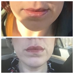 Phoenix Integrative Medicine - Juvaderm, top lip only