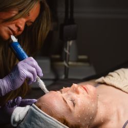 Reniassance Medical Spa - Amanda performing microneedling with SkinPen.