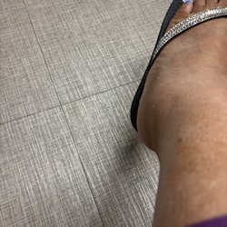 GuideWell Emergency Doctors - Parasite  beneath my feet causing edema.