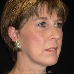 Elite Facial Plastic Surgery - Simplicity Facelift After