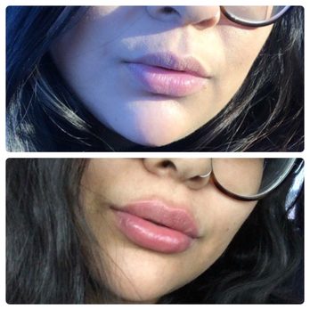 Zona Med Spa - Top is my lips before. Bottom is immediately after 1 syringe of filler. - Skin Care Near Me - Scottsdale, Arizona Zona Med Spa - Top is my lips before. Bottom is immediately after 1 syringe of filler. - Skin Care Near Me - Scottsdale, Arizona