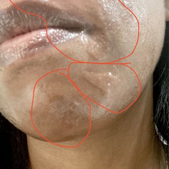 Amber eyebrow threading - Swelling prior to the discoloration - Eyebrow Services Near Me - Glendale, Arizona Amber eyebrow threading - Swelling prior to the discoloration - Eyebrow Services Near Me - Glendale, Arizona