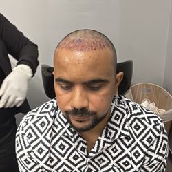 Anderson Center for Hair - Hair transplant