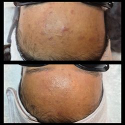 Hanis Spa - Before and after