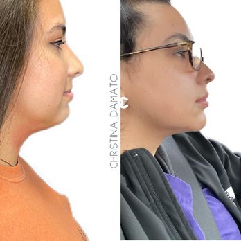 Aesthetica MedSpa - Kybella before and after - Medical Spas Near Me - Austin, Texas Aesthetica MedSpa - Kybella before and after - Medical Spas Near Me - Austin, Texas