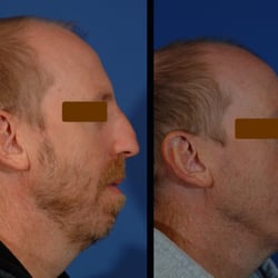 Art of Facial Surgery - Before & After Rhinoplasty and Chin Implant