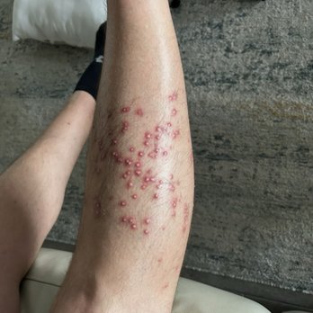 Houston HOA Management - Ant bites from the hidden ant piles you can't see because the HOA won't do a simple task of pest control or consistent mowing - Homeowner Association Near Me - Houston, Texas Houston HOA Management - Ant bites from the hidden ant piles you can't see because the HOA won't do a simple task of pest control or consistent mowing - Homeowner Association Near Me - Houston, Texas