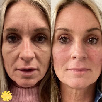 The Marigold Spa - Combination of 3 Morpheus8 Treatments, Botox, and Dermal Fillers. - Medical Spas Near Me - Downingtown, Pennsylvania The Marigold Spa - Combination of 3 Morpheus8 Treatments, Botox, and Dermal Fillers. - Medical Spas Near Me - Downingtown, Pennsylvania