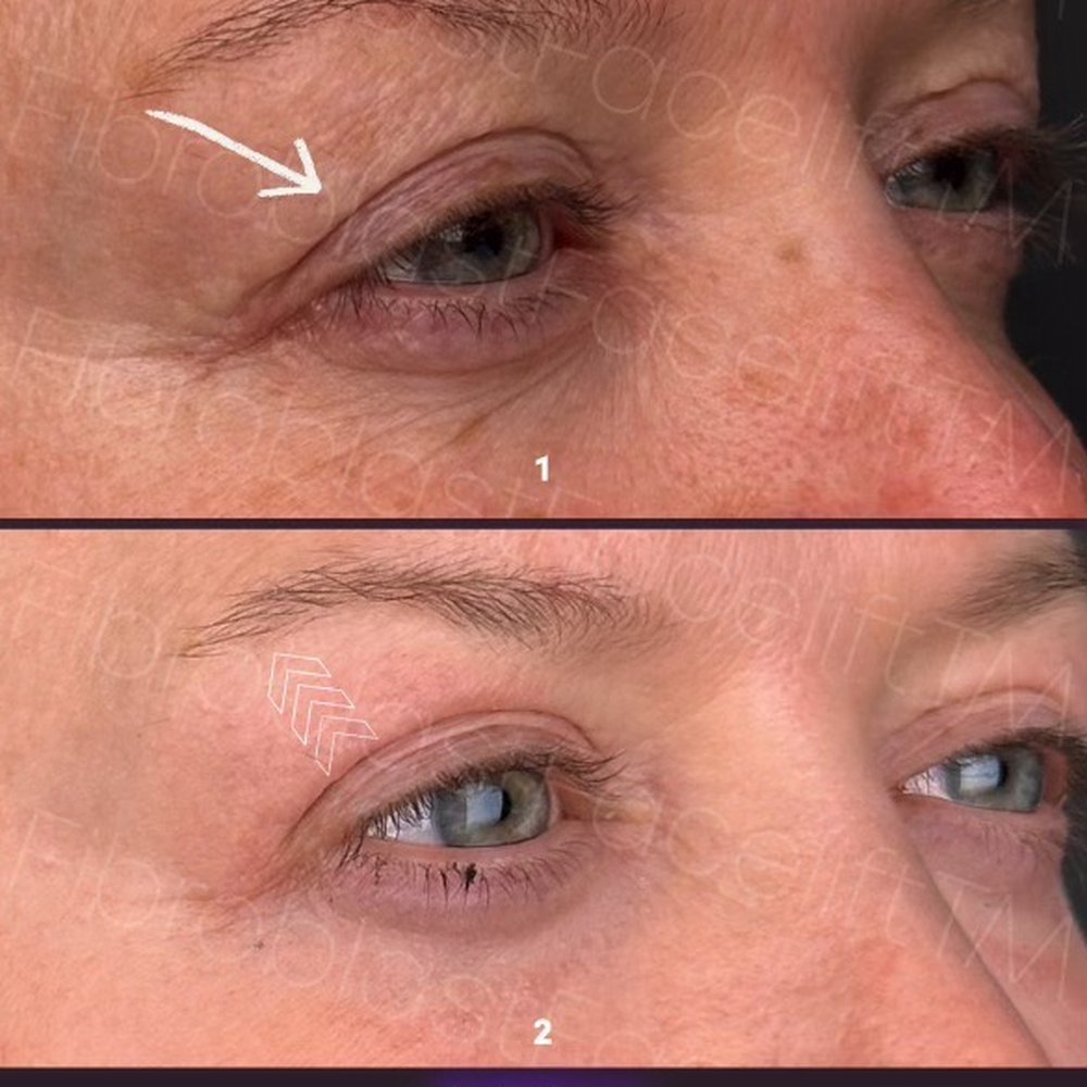 Fibroblast Facelift - Lifted lid - Skin Care Near Me - Pasadena, California
