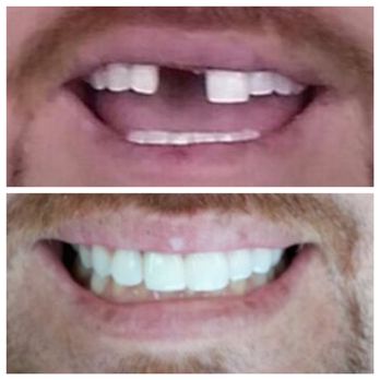 Victor De Los Santos, DDS - Replaced his flipper with an implant and closed the wide gap. - Oral Surgeons Near Me - Long Beach, California Victor De Los Santos, DDS - Replaced his flipper with an implant and closed the wide gap. - Oral Surgeons Near Me - Long Beach, California