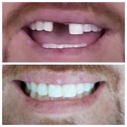 Victor  De Los Santos, DDS - Replaced his flipper with an implant and closed the wide gap.