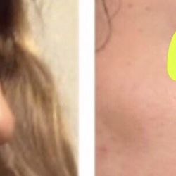 New Reflections Plastic Surgery - Rhinoplasty - one week post-op photo