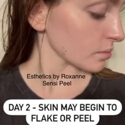 Esthetics by Roxanne - PCA Skin Sensi Peel, as well as the popular 4% Retinol Peel--target wrinkles, dark spots and dull skin. Acne solutions also offered.