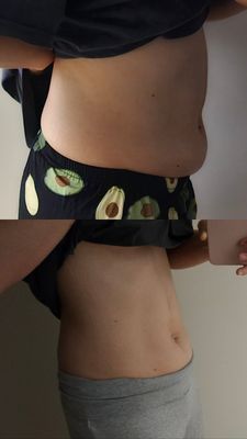 ESCULPT - EMSCULPT is a revolutionary body sculpting treatment that utilizes high-intensity focused electromagnetic technology to help build and tone muscles while simultaneously reducing fat, resulting in a more sculpted and defined physique.