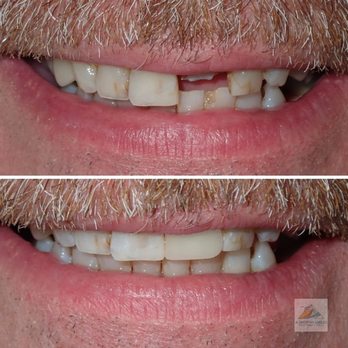 A Shop For Smiles - Ruben Mora DDS - Same-day dental crowns before and after - Oral Surgeons Near Me - La Mesa, California A Shop For Smiles - Ruben Mora DDS - Same-day dental crowns before and after - Oral Surgeons Near Me - La Mesa, California