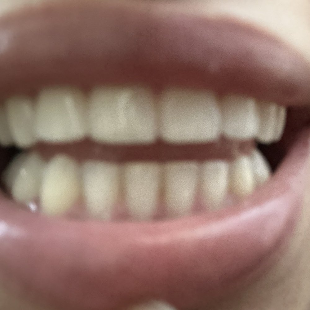 Braces Now - After Invisalign and ridge shaping results - Orthodontists Near Me - Norcross, Georgia Braces Now - After Invisalign and ridge shaping results - Orthodontists Near Me - Norcross, Georgia