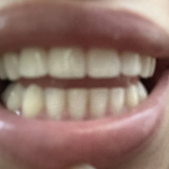 Braces Now - After Invisalign and ridge shaping results - Orthodontists Near Me - Norcross, Georgia Braces Now - After Invisalign and ridge shaping results - Orthodontists Near Me - Norcross, Georgia