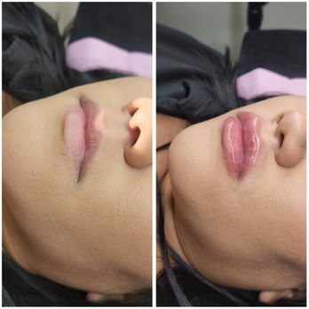 Boîte De Beauté - Needless lip filler - Eyelash Service Near Me - Chandler, Arizona Boîte De Beauté - Needless lip filler - Eyelash Service Near Me - Chandler, Arizona