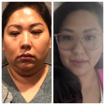 Skin Addiction and Health Care - Kybella Before & After - Medical Spas Near Me - Bothell, Washington Skin Addiction and Health Care - Kybella Before & After - Medical Spas Near Me - Bothell, Washington