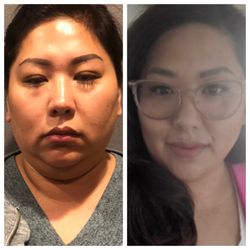 Skin Addiction and Health Care - Kybella Before & After