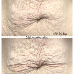 Skin Care By Nadina - This is after 1 session of fibroblast plasma service. This is after 30 days. Full results in 90 days.   Results vary.