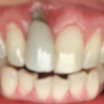 A1 Dental Care - And my crown is discolored - General Dentistry Near Me - Las Vegas, Nevada A1 Dental Care - And my crown is discolored - General Dentistry Near Me - Las Vegas, Nevada