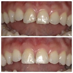 Chad Lyew, DDS - Alemany Dental - Cosmetic bonding for two front teeth.