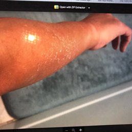 I emailed them with my pathetic peeling pics I emailed them with my pathetic peeling pics