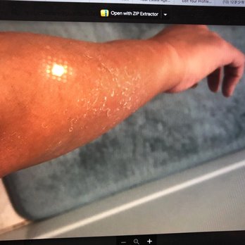 Palm Beach Tan - I emailed them with my pathetic peeling pics - Skin Care Near Me - Rockville, Maryland Palm Beach Tan - I emailed them with my pathetic peeling pics - Skin Care Near Me - Rockville, Maryland