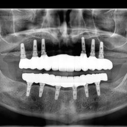 Luxor Dental - All on X Full Arch
Dental Implant Surgery and Fixed Bridges by Dr. Michel Raad Luxor Dental