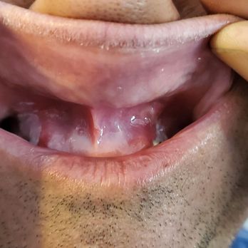 Smile by Dr K - Explained in paragraph above. (Grayish discoloring is from chemical applied to my gums that burned them.) - Orthodontists Near Me - Chatsworth, California Smile by Dr K - Explained in paragraph above. (Grayish discoloring is from chemical applied to my gums that burned them.) - Orthodontists Near Me - Chatsworth, California