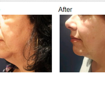 Symmetry Medspa - Case #145 - Morpheus8 Before - 3 Months After Individual results may vary. - Medical Spas Near Me - Montgomery, Alabama Symmetry Medspa - Case #145 - Morpheus8 Before - 3 Months After Individual results may vary. - Medical Spas Near Me - Montgomery, Alabama