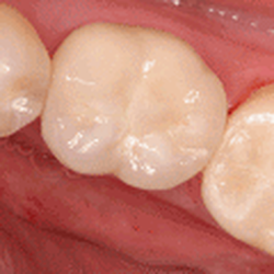 Advanced Dental Arts - Rey Martinez, DDS - Before & After Crowns